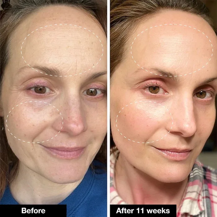 INNBEAUTY Project Retinol Remix 1% Retinol Treatment With Peptide & Tranexamic Acid