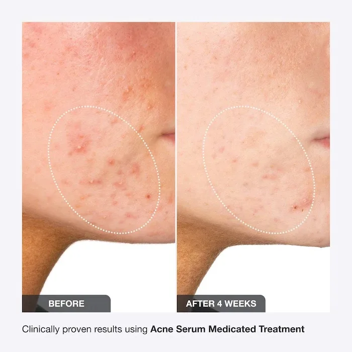 INNBEAUTY Project Acne Serum Medicated Treatment for Acne & Blackheads