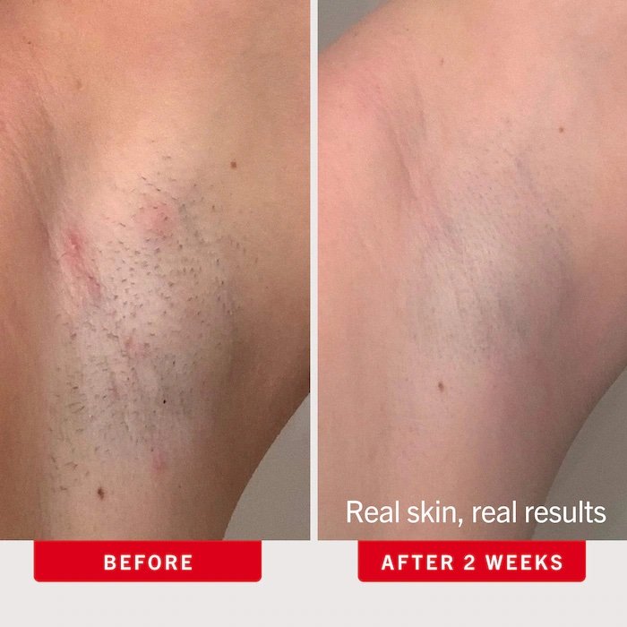 First Aid Beauty Ingrown Hair Pads with AHA + BHA for Body + Face