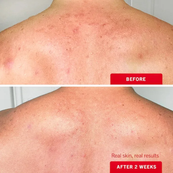 First Aid Beauty Body Acne Clearing Mist -2% Salicylic Acid Acne Treatment