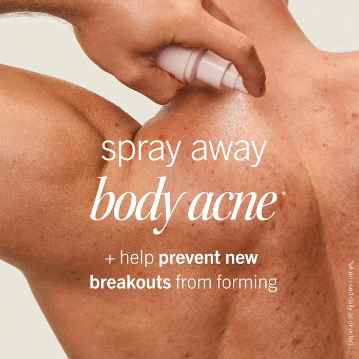 First Aid Beauty Body Acne Clearing Mist -2% Salicylic Acid Acne Treatment